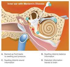 Vestibular Therapy