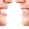 Clear Aligners Vs. Traditional Braces: Which Is Right For You?