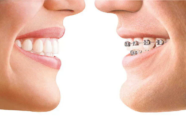 Clear Aligners Vs. Traditional Braces: Which Is Right For You?
